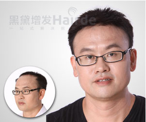 頭發稀少，細軟可以補發嗎0595-22867702