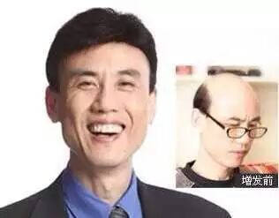 假發.補發.增發那個效果好